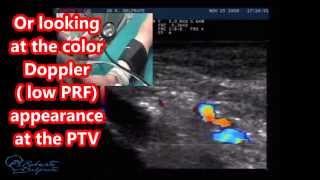 Non invasive Venous Pressure measurement : Doppler