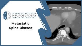 Metastatic Spine Disease