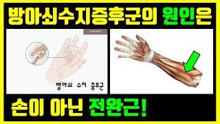 방아쇠수지증후군(Trigger Finger/Thumb) 스트레칭 운동 및 자가치료, Gliding technique, 예방법