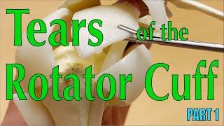 Tears of the Rotator Cuff Part 1