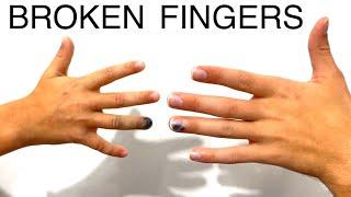 BROKEN BONES AGAIN  | The Mum of 10