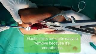 IM Elastic nailing removal | Adamya Hosp video