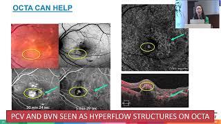 AIOC2024  GP10 Topic  Dr Anna TAN Diagnosis and management of PCV with non invasive imaging