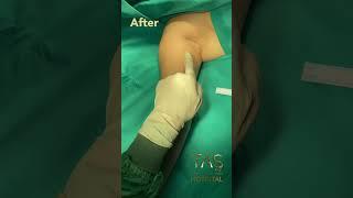 Transform Your Arms with Scarless Arm Lift by Dr. TAS | Expert Insights