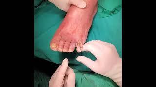 S2.Musical note bending (@-shape bending) of K-wire at Toe fixation (Case1. Kang's method)