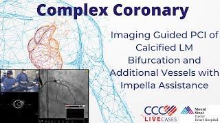 Imaging Guided PCI of Calcified LM Bifurcation and Additional Vessels with Impella Assistance