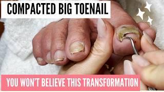 Ultimate Pedicure Transformation | Thick Toenail & Foot Care Secrets Revealed