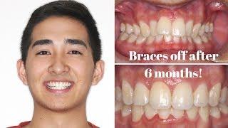 The process of getting braces at Breckinridge Dental and Orthodontics