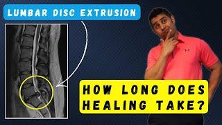 How Long Does It Take for a Disc Extrusion to heal? Find Out