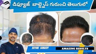 Hair Transplant In Hyderabad | Best Surgeon Results & Clinic Of Hair Transplant Surgery In Hyderabad