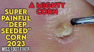 SUPER PAINFUL " DEEP SEATEDD CORN" 2023 [ A MIGHTY CORN] BY MISS FOOT FIXER