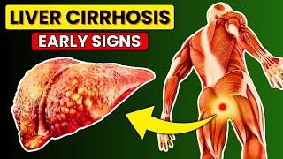 Liver Damage! 12 Early Signs & Symptoms of LIVER CIRRHOSIS | Heal Now