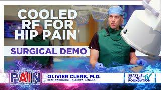 Cooled RF for Hip Pain - Olivier Clerk, M.D.