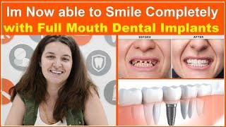 Full Mouth Dental Implants Reviews || Best Dental Clinic In Hyderabad || Eledent Dental Hospitals