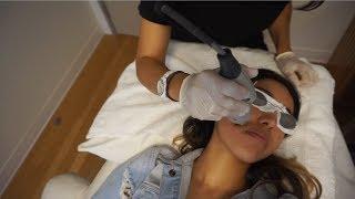 Vlog: laser for acne & red scars Ava MD Santa Monica