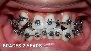 Niềng răng khểnh sau 2 năm | After 2 years braces #orthodontist