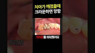 Do not dental Crown. You're screwed if you get a crown on your broken tooth.