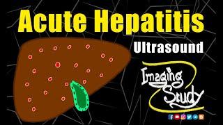 Acute Hepatitis || Ultrasound Lecture || Imaging Study