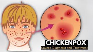 Chickenpox, Causes, Signs and Symptoms, Diagnosis and Treatment.