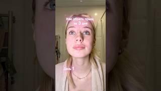 Как убрать прыщи за несколько дней 