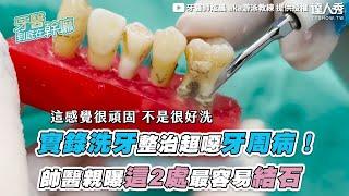 【實錄洗牙整治超噁牙周病！  帥醫親曝這2處最容易結石】｜@dentistxuan