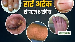 Heart Attack precautions & Preventions | Heart Attack Kaise samjhe Aur Kya bachav Karen