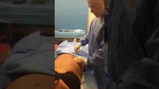 Dr. Mullins Performs Smart Lipo on Patient