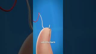 How To Remove A Fishhook 