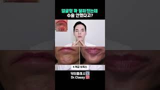 성형수술 NO! 얼굴윤곽 확 바뀌는 보톡스 공개