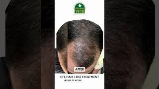 Studio 1915 Luxury Aesthetic Clinic | GFC Hair Loss Treatment